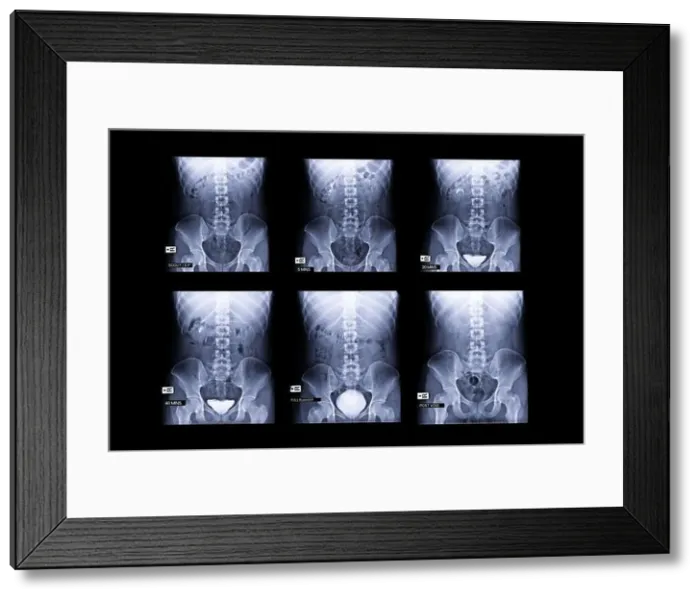 Framed Print : procedure of Intravenous pyelogram or I.V.P is an X-ray exam of urinary tract after injection contrast media agent 5, 20, 40 minute, Fullbladder Framed Print : procedure of Intravenous pyelogram or I.V.P is an X-ray exam of urinary tract after injection contrast media agent 5, 20, 40 minute, Fullbladder