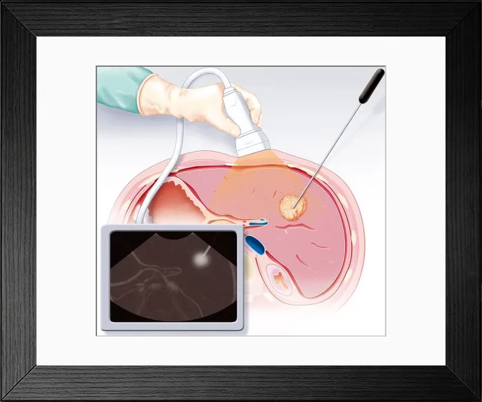Framed Print : RADIOFREQUENCY ABLATION