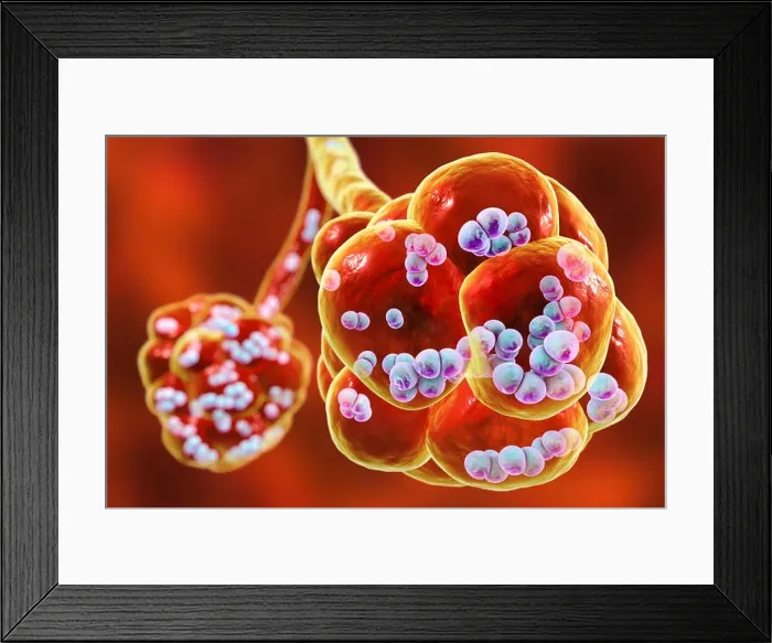 Framed Print : Pneumococcal pneumonia. Computer illustration of Streptococcus pneumoniae (pneumococci) bacteria inside the alveoli of the lungs, causing pneumonia Framed Print : Pneumococcal pneumonia. Computer illustration of Streptococcus pneumoniae (pneumococci) bacteria inside the alveoli of the lungs, causing pneumonia