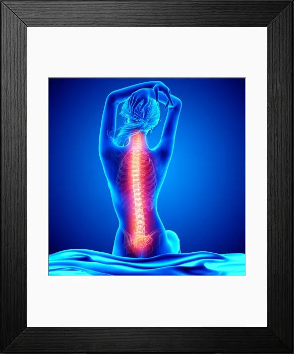 Framed Print : Back pain, artwork Framed Print : Back pain, artwork