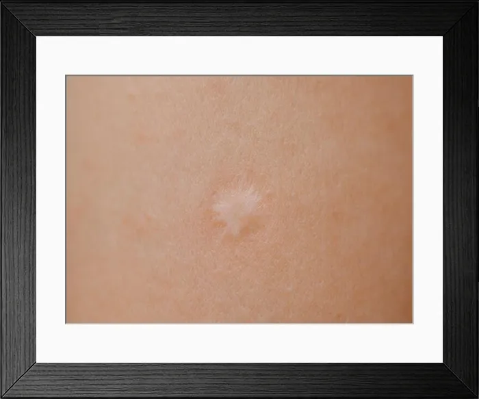 Framed Print : Close-up of scar of BCG vaccination on the human arm Framed Print : Close-up of scar of BCG vaccination on the human arm