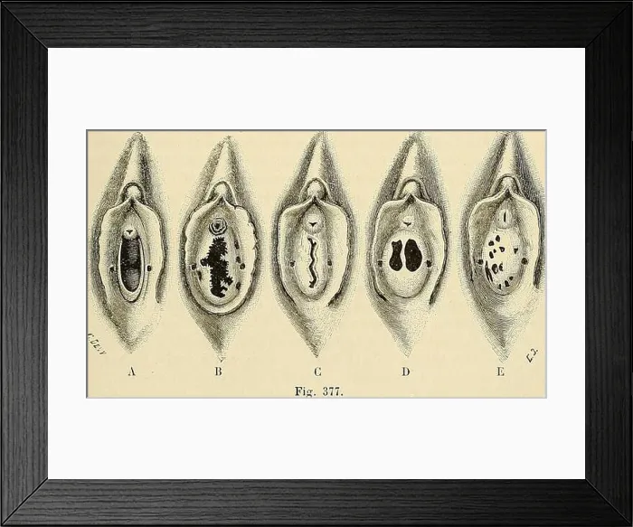 Framed Print : Traité d'anatomie humaine : anatomie descriptive, histologie, développement. urgien quand il sagit de pratiquer le cathétérismede lurèthre sans Framed Print : Traité d'anatomie humaine : anatomie descriptive, histologie, développement. urgien quand il sagit de pratiquer le cathétérismede lurèthre sans