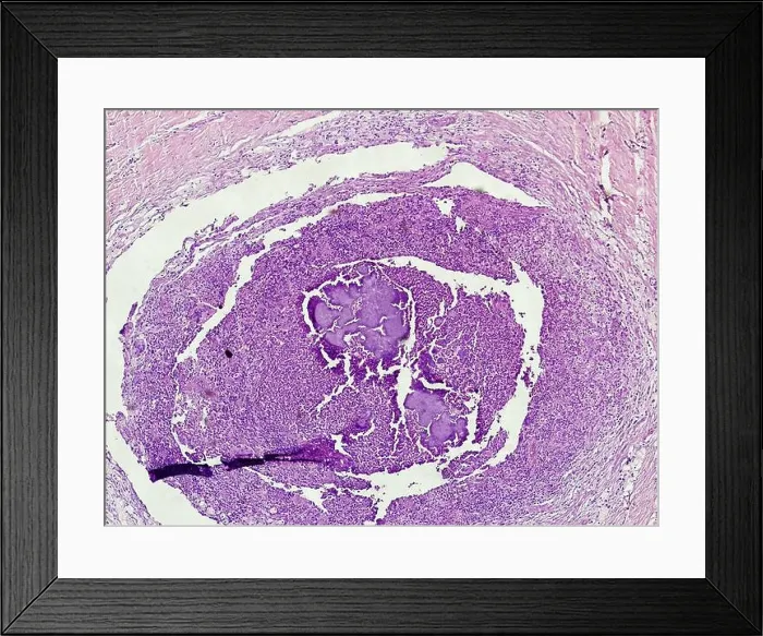 Framed Print : Microscopic image of Mycetoma. Mycetoma is a disease that is usually acquired through work in agriculture and generally affects men who contract Framed Print : Microscopic image of Mycetoma. Mycetoma is a disease that is usually acquired through work in agriculture and generally affects men who contract