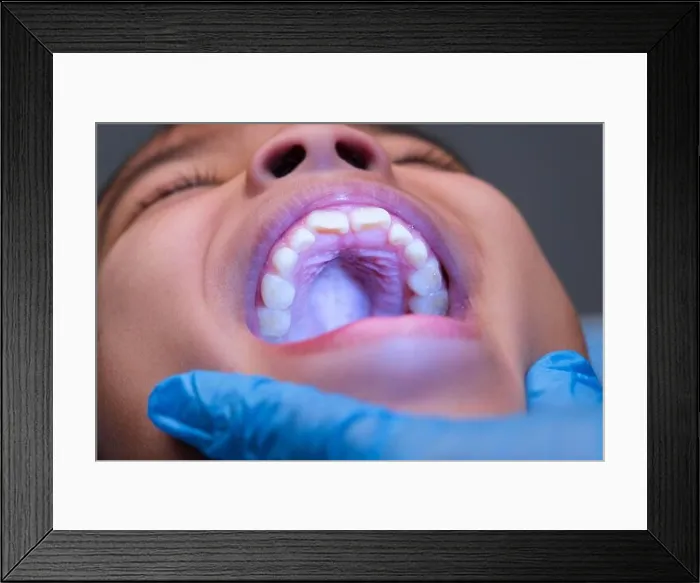 Framed Print : Close-up inside the oral cavity of a healthy child with beautiful rows of baby teeth. Young girl opens mouth revealing upper and lower teeth, hard pal Framed Print : Close-up inside the oral cavity of a healthy child with beautiful rows of baby teeth. Young girl opens mouth revealing upper and lower teeth, hard pal