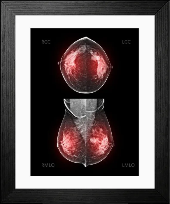 Framed Print : X-ray Digital Mammogram both side CC and MLO view. mammography or breast scan for Breast cancer BI-RADS 5; Highly suggestive of malignancy Framed Print : X-ray Digital Mammogram both side CC and MLO view. mammography or breast scan for Breast cancer BI-RADS 5; Highly suggestive of malignancy