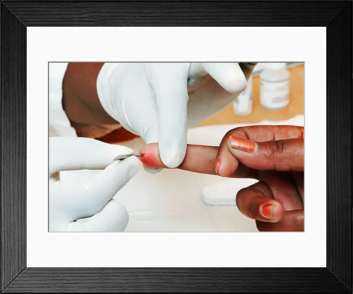 Framed Print : Finger pricked for HIV testing Johannesburg Gauteng Province South Africa Framed Print : Finger pricked for HIV testing Johannesburg Gauteng Province South Africa