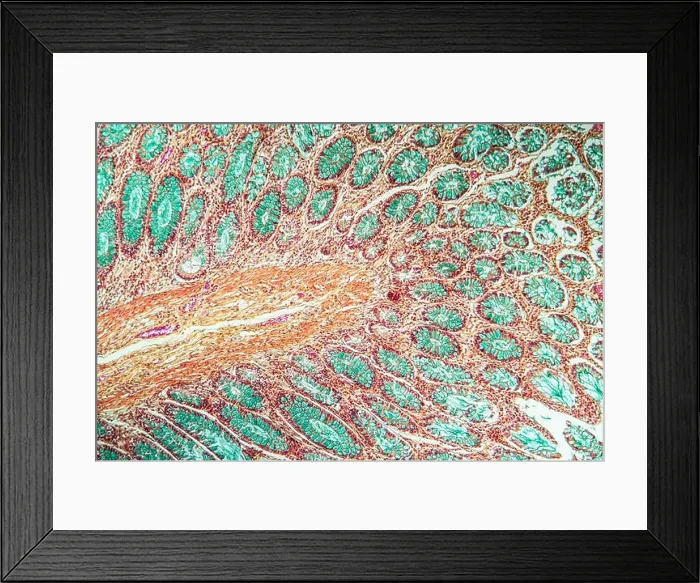 Framed Print : Colon cancer tissue section under the microscope 100x Framed Print : Colon cancer tissue section under the microscope 100x