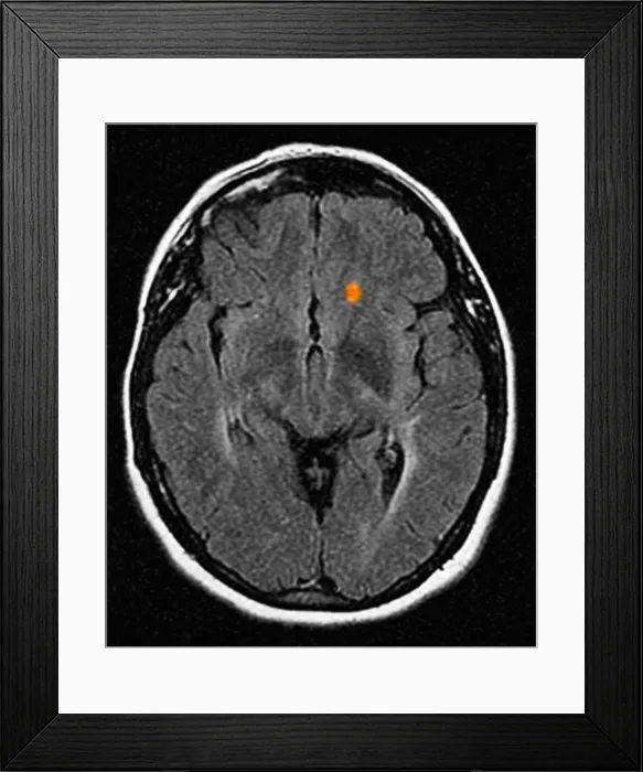 Framed Print : CT scan of brain showing multiple sclerosis Framed Print : CT scan of brain showing multiple sclerosis