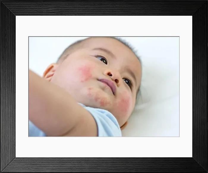 Framed Print : Baby has an allergic reaction to the face, Skin rashes in babies concept Framed Print : Baby has an allergic reaction to the face, Skin rashes in babies concept