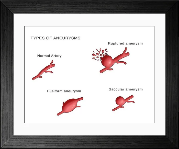 Framed Print : Types of Aneurysms Framed Print : Types of Aneurysms