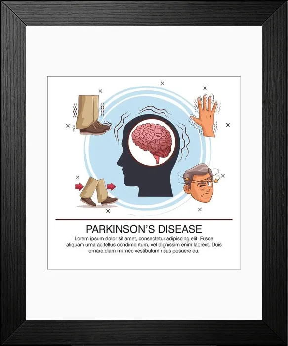 Framed Print : Parkinsons disease infographic Framed Print : Parkinsons disease infographic