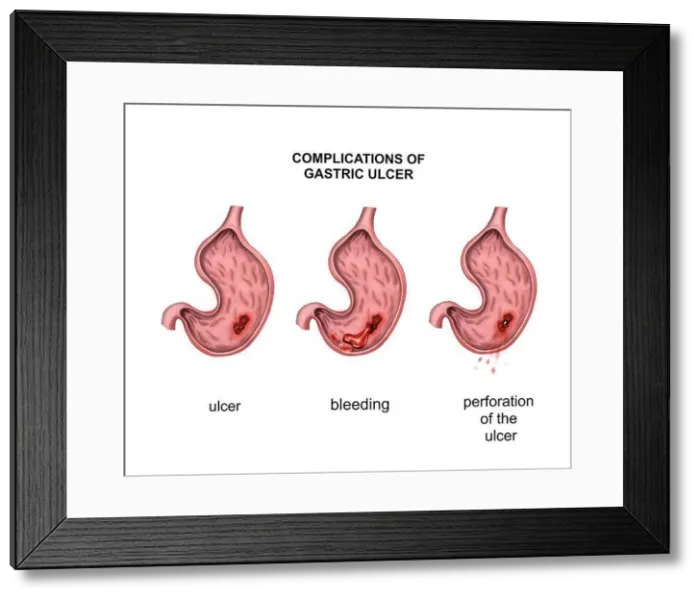 Framed Print : Complications of gastric ulcer. Bleeding and perforation