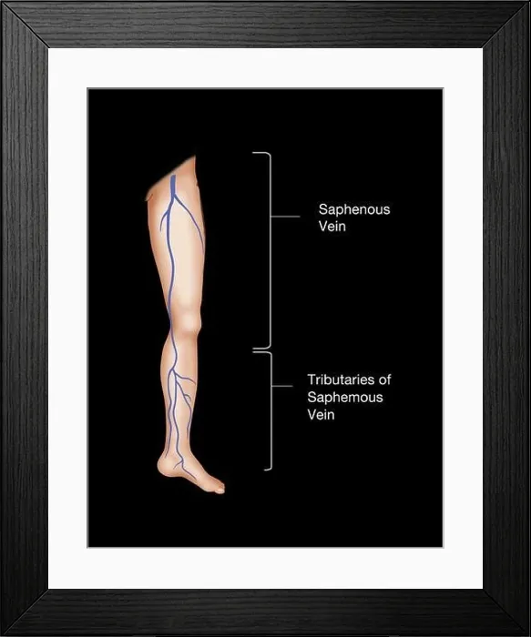 Framed Print : Saphenous Vein in the Leg Framed Print : Saphenous Vein in the Leg