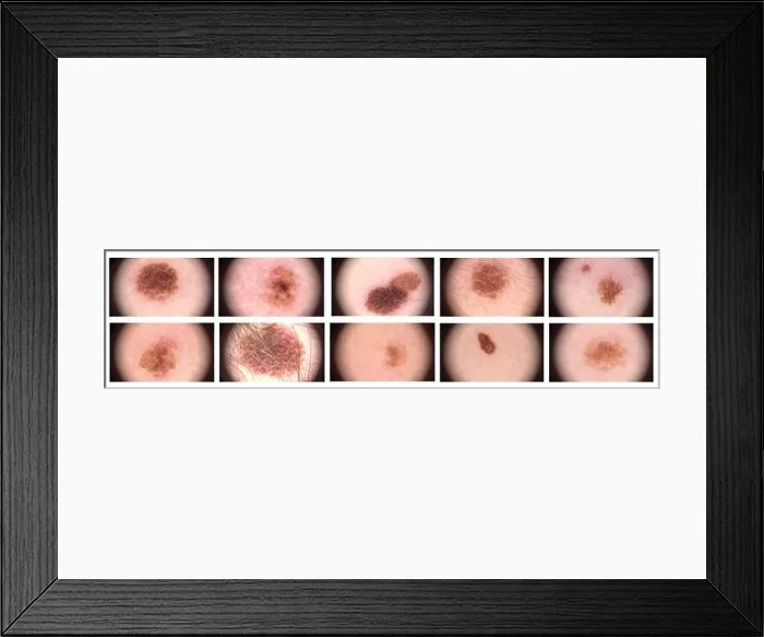 Framed Print : Complex melanocytic nevus. Dermatoscopy of the skin. Macro magnified 20 times with a dermatoscope microscope. A set of different nevus Framed Print : Complex melanocytic nevus. Dermatoscopy of the skin. Macro magnified 20 times with a dermatoscope microscope. A set of different nevus
