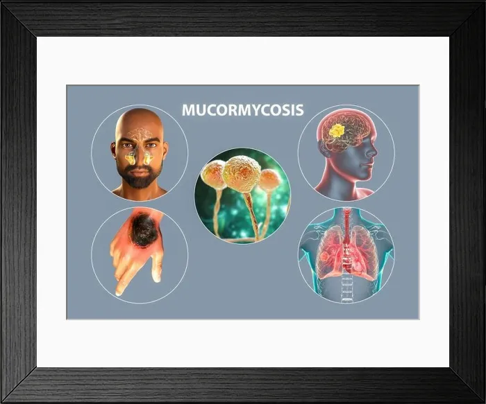 Framed Print : Clinical forms of mucormycosis, illustration Framed Print : Clinical forms of mucormycosis, illustration