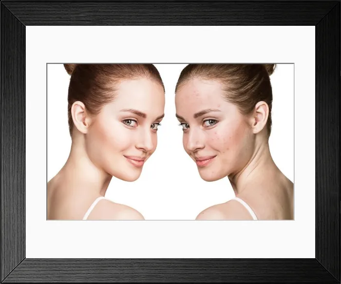 Framed Print : Comparison portrait of young girl with problematic skin before and after treatment Framed Print : Comparison portrait of young girl with problematic skin before and after treatment