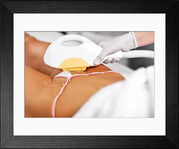 Framed Print : Picture Of Beautician Giving Epilation Laser Treatment To Woman On Bikini Framed Print : Picture Of Beautician Giving Epilation Laser Treatment To Woman On Bikini
