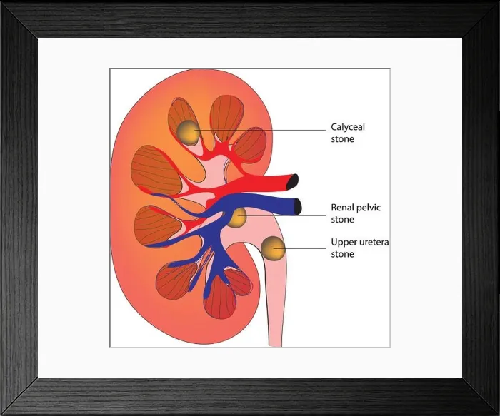 Framed Print : Detailed diagram of kidney stone Framed Print : Detailed diagram of kidney stone