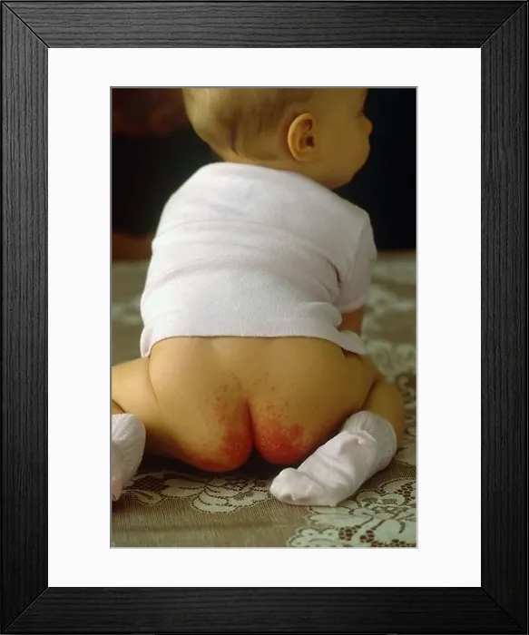 Framed Print : DIAPER ERYTHEMA