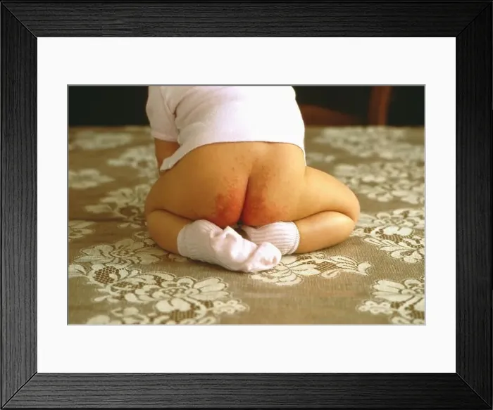Framed Print : Diaper erythema Framed Print : Diaper erythema