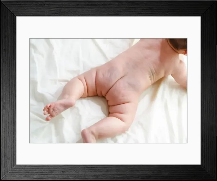 Framed Print : Baby, mongolian spots