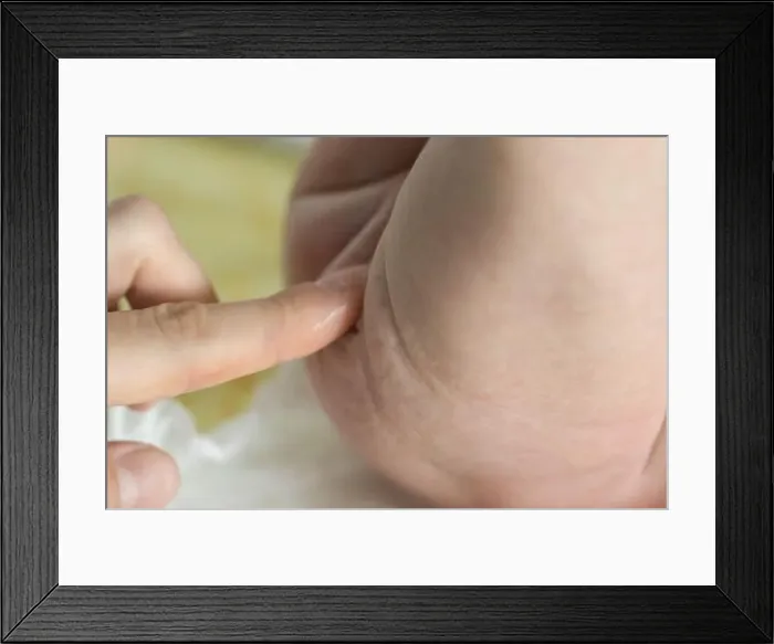Framed Print : mother smears cream on the baby's reddened ass Framed Print : mother smears cream on the baby's reddened ass