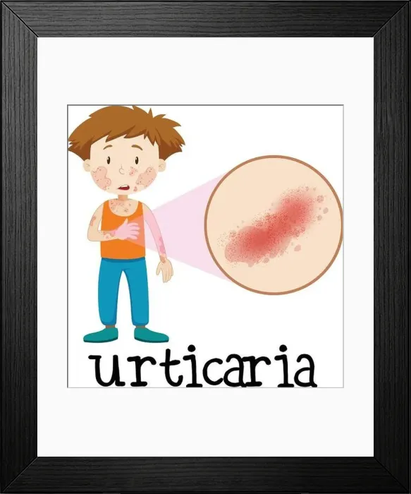 Framed Print : A Vector of Skin Urticaria illustration Framed Print : A Vector of Skin Urticaria illustration