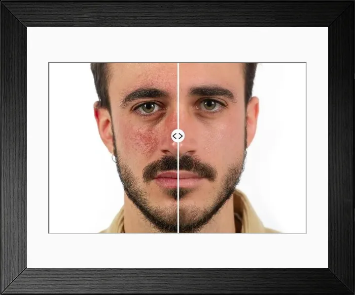 Framed Print : Caucasian male face with red skin rosacea before and after couperose treatment Framed Print : Caucasian male face with red skin rosacea before and after couperose treatment