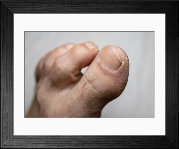 Framed Print : Older man feet fingers - dry skin - Shallow focus blur background