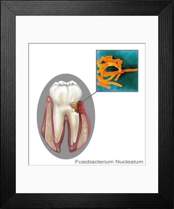 Framed Print : Fusobacterium nucleatum, oral bacteria found in the dental plaque of humans Framed Print : Fusobacterium nucleatum, oral bacteria found in the dental plaque of humans