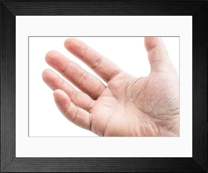 Framed Print : image of the mens hand showing skin disease isolated on white background Framed Print : image of the mens hand showing skin disease isolated on white background