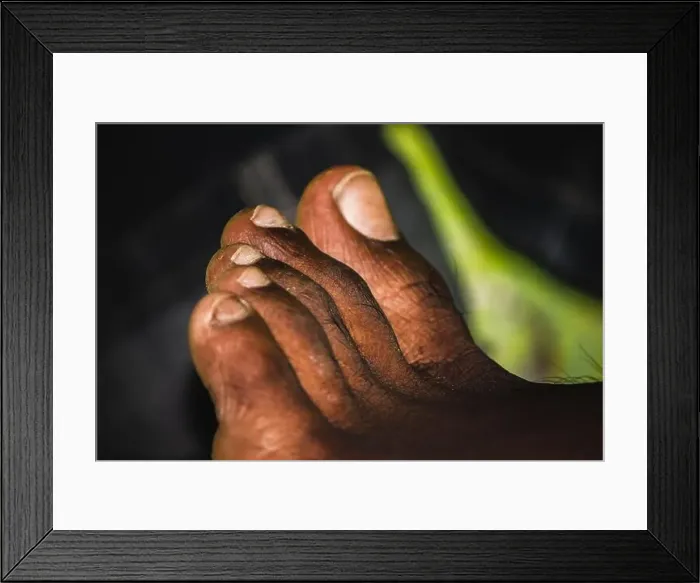 Framed Print : Dark skin man foot - Close-up toenail Fungus - Nail Fungus on Legs of black man Framed Print : Dark skin man foot - Close-up toenail Fungus - Nail Fungus on Legs of black man