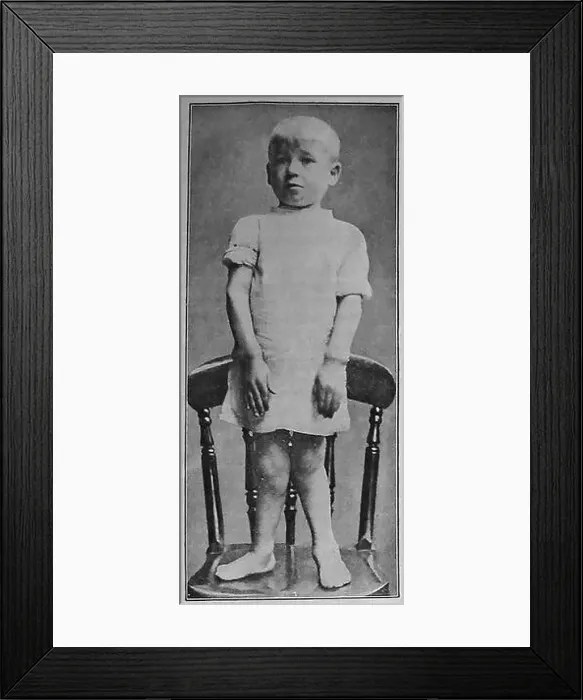 Framed Print : A 1920 illustration of a child with rickets showing symptoms of deformed legs and thickened wrists and ankles Framed Print : A 1920 illustration of a child with rickets showing symptoms of deformed legs and thickened wrists and ankles
