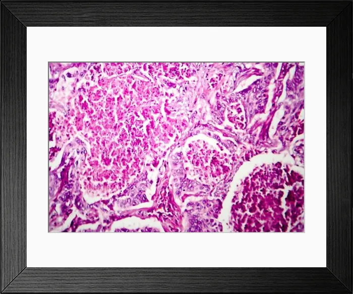 Framed Print : Lung adenocarcinoma, light micrograph, photo under microscope Framed Print : Lung adenocarcinoma, light micrograph, photo under microscope