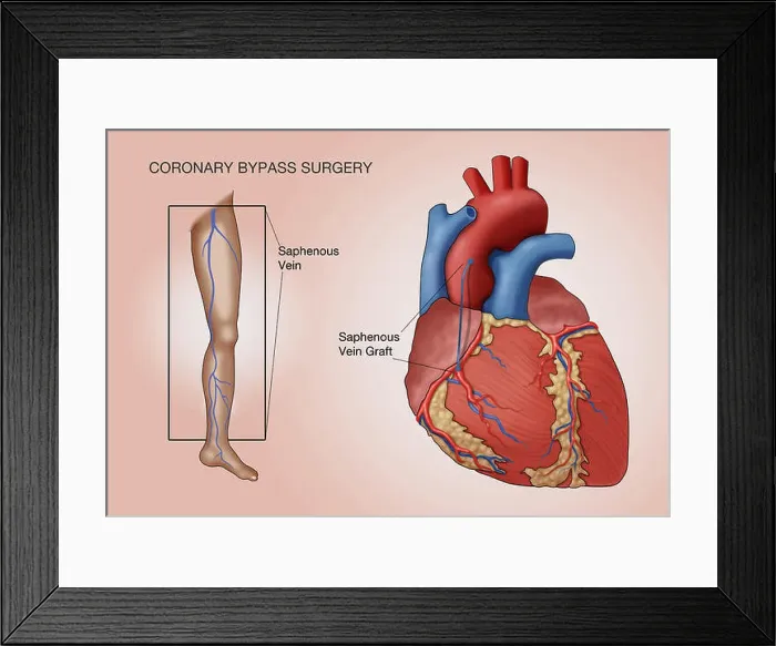 Framed Print : Coronary bypass surgery, labeled illustration Framed Print : Coronary bypass surgery, labeled illustration
