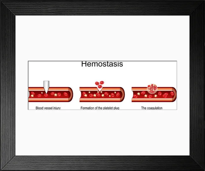 Framed Print : Hemostasis. Cross section of a Blood Vessel after injury Framed Print : Hemostasis. Cross section of a Blood Vessel after injury