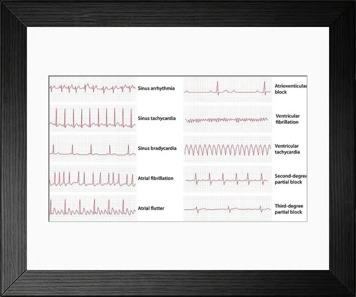 Framed Print : Schemes set of common electrocardiogram (ECG) abnormalities, including partial blocks and flutter Framed Print : Schemes set of common electrocardiogram (ECG) abnormalities, including partial blocks and flutter