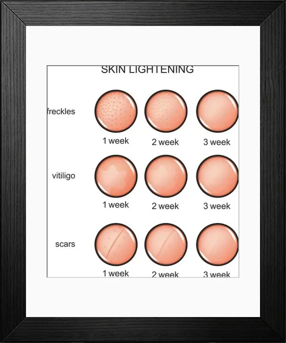 Framed Print : vector illustration of lightening of the skin. freckles, vitiligo, scars Framed Print : vector illustration of lightening of the skin. freckles, vitiligo, scars