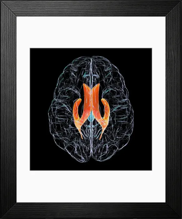Framed Print : Lateral brain ventricles, illustration Framed Print : Lateral brain ventricles, illustration