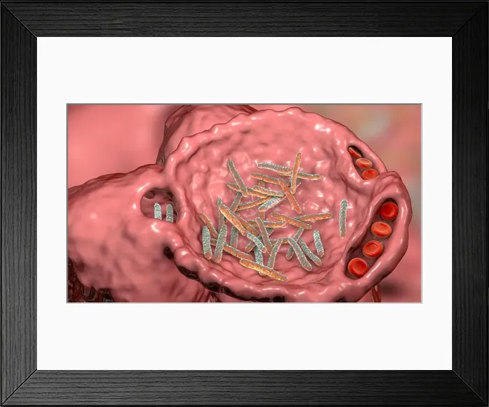 Framed Print : Bacterial pneumonia. Computer illustration of rod-shaped bacteria (bacilli) inside the alveoli of the lungs Framed Print : Bacterial pneumonia. Computer illustration of rod-shaped bacteria (bacilli) inside the alveoli of the lungs