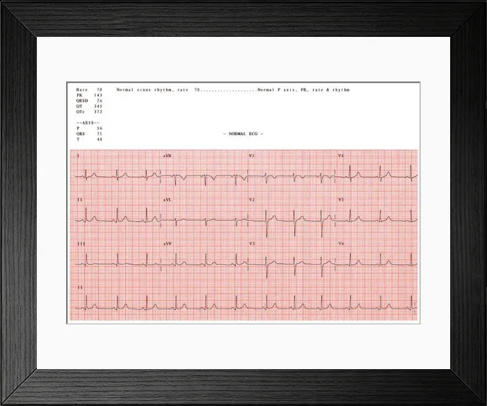 Framed Print : Normal electrocardiogram Framed Print : Normal electrocardiogram