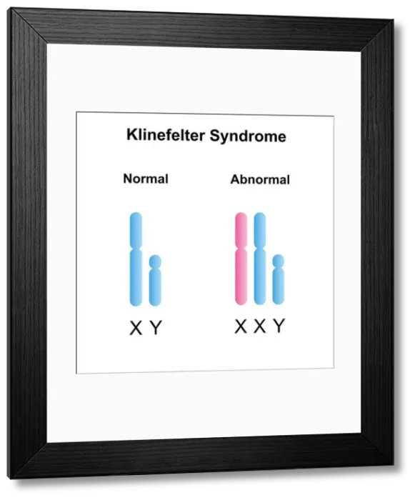 Framed Print : Klinefelter syndrome, illustration Framed Print : Klinefelter syndrome, illustration