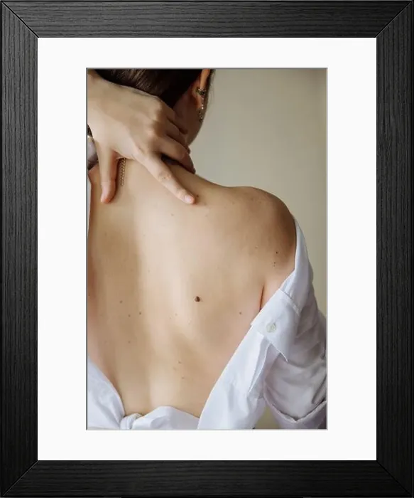 Framed Print : The back of a white girl with moles large and small Framed Print : The back of a white girl with moles large and small