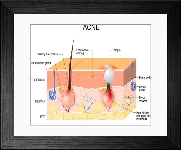 Framed Print : Acne vulgaris or pimple. healthy hair follicle and clogged pore Framed Print : Acne vulgaris or pimple. healthy hair follicle and clogged pore