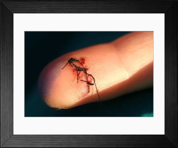 Framed Print : Closeup of a finger with three sutures Framed Print : Closeup of a finger with three sutures