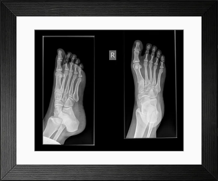 Framed Print : x-ray of a foot showing a fracture in the proximal phalanx of the big toe on the righ foot of a 30 year old female Framed Print : x-ray of a foot showing a fracture in the proximal phalanx of the big toe on the righ foot of a 30 year old female
