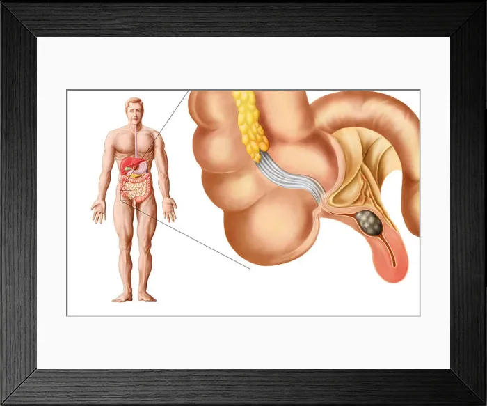 Framed Print : Medical ilustration of an appendix with appendicitis Framed Print : Medical ilustration of an appendix with appendicitis
