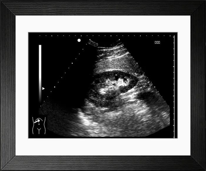 Framed Print : Healthy kidney, ultrasound scan Framed Print : Healthy kidney, ultrasound scan