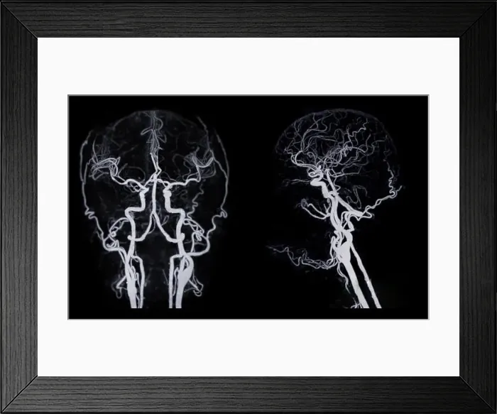 Framed Print : CT angiography of the brain or CTA brain showing Cerebral artery