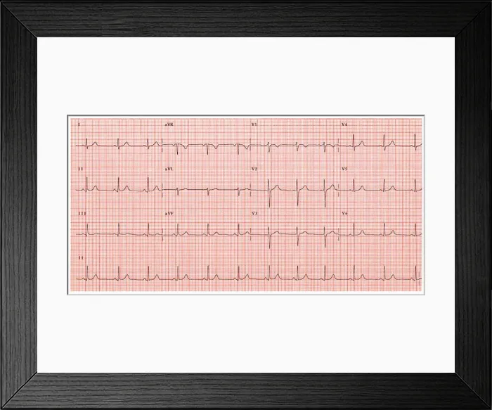 Framed Print : Normal electrocardiogram Framed Print : Normal electrocardiogram